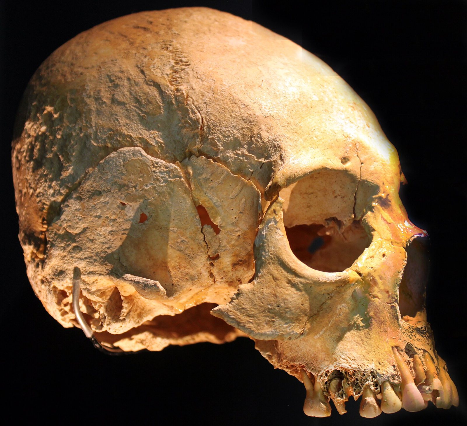 Skull of an early medieval woman seen from the front left against a black ground, with a tall rounded braincase, a large eye socket and a thin metal support wire at the back