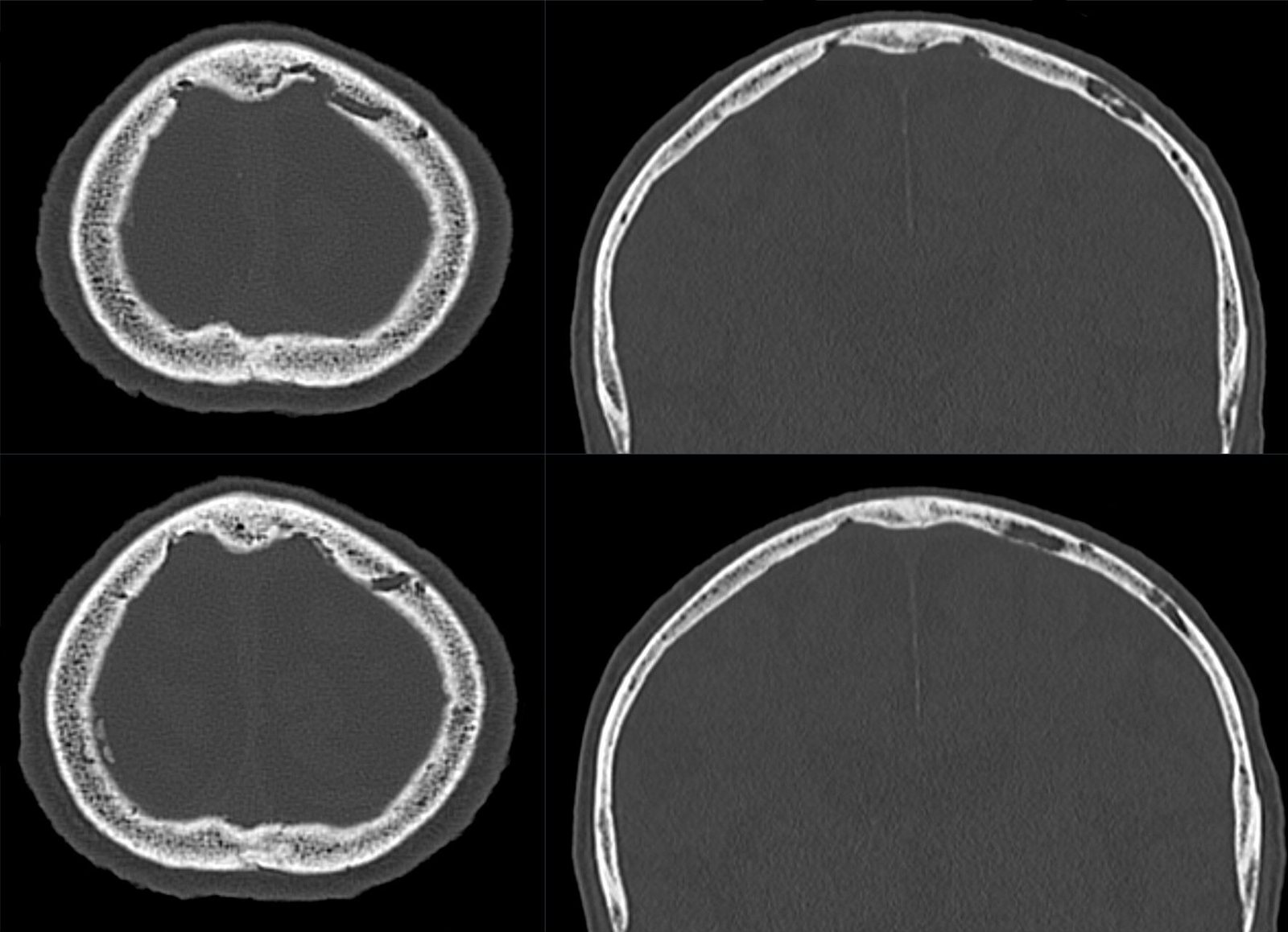 Four black-and-white CT slices of a skull vault, two horizontal rings and two arches, showing a dense outer layer, a spongy middle layer and a dense inner layer