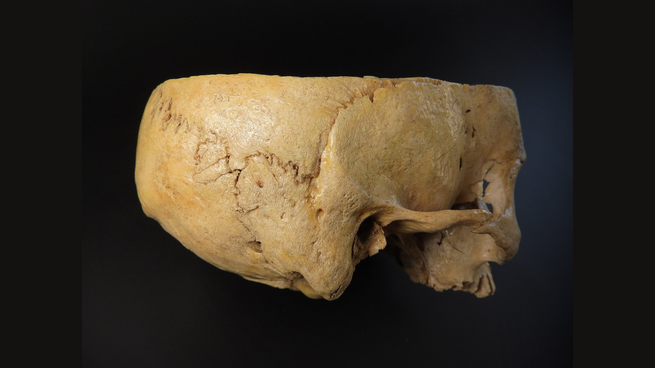 A human cranium seen from the side against a black background, the face missing, with the thick curved bone of the skull vault and the sutures along its surface