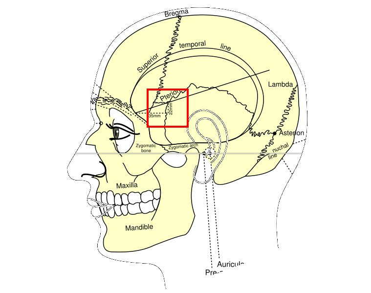 A line diagram of a human head and skull from the side, with the bones and sutures labelled and a red box marking the pterion at the temple