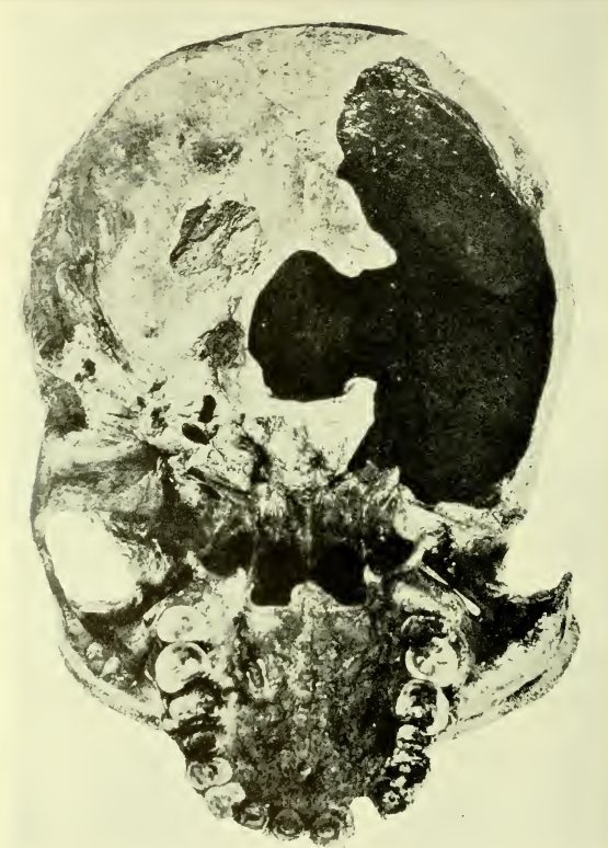 An old black-and-white plate of the Kabwe 1 skull seen from below, showing the palate and tooth sockets along the lower edge and a large dark opening in the damaged base