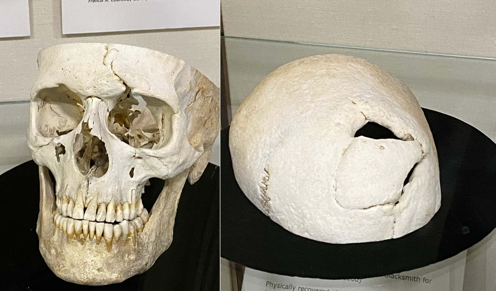 Two views of Phineas Gage's skull in a museum case: on the left the face and jaw with damage above the left eye socket, on the right the separate skull cap with a large healed opening near the top