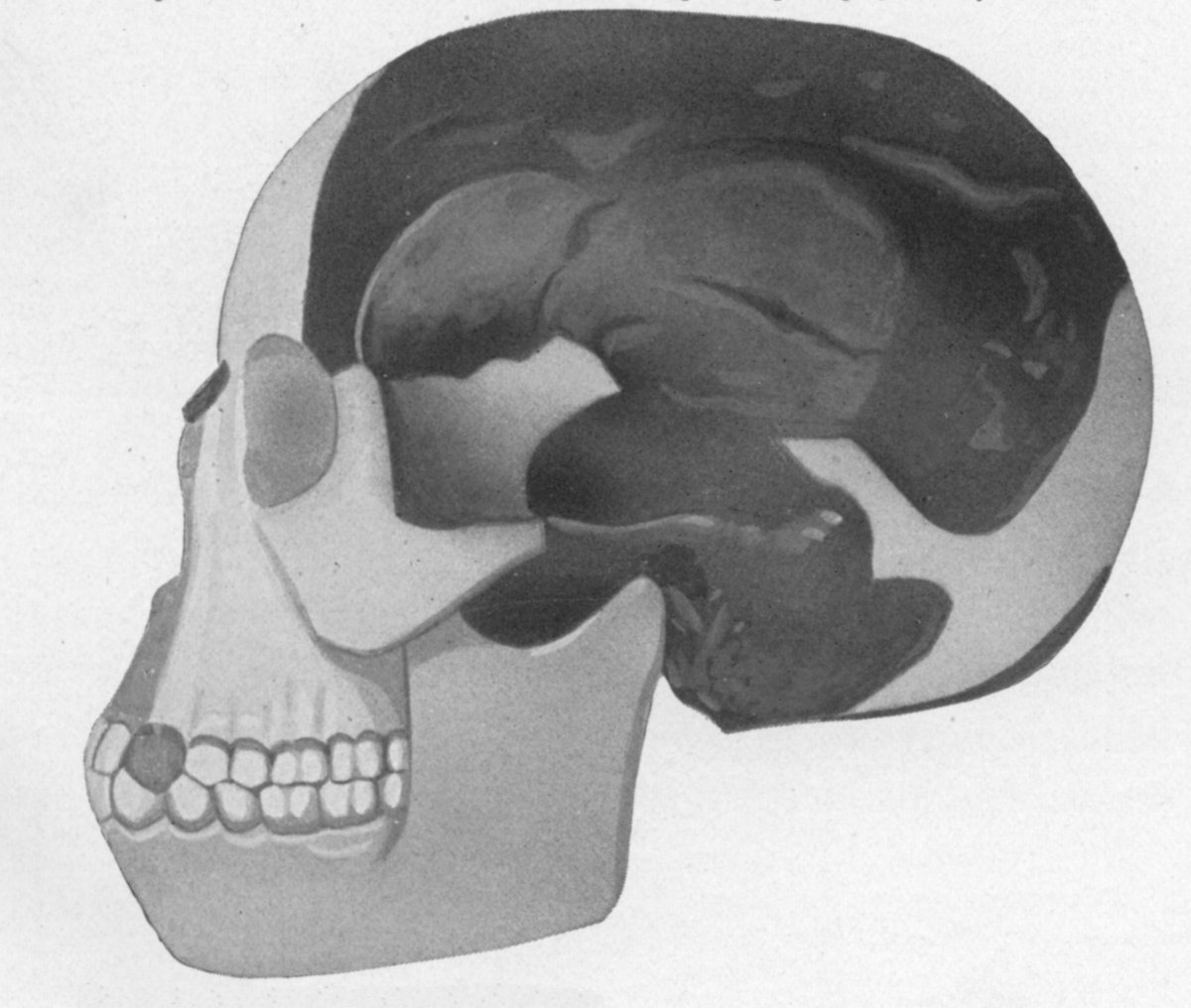 Drawing of the Piltdown skull reconstruction in side view, with the dark braincase fragments and the lighter reconstructed face, jaw and teeth