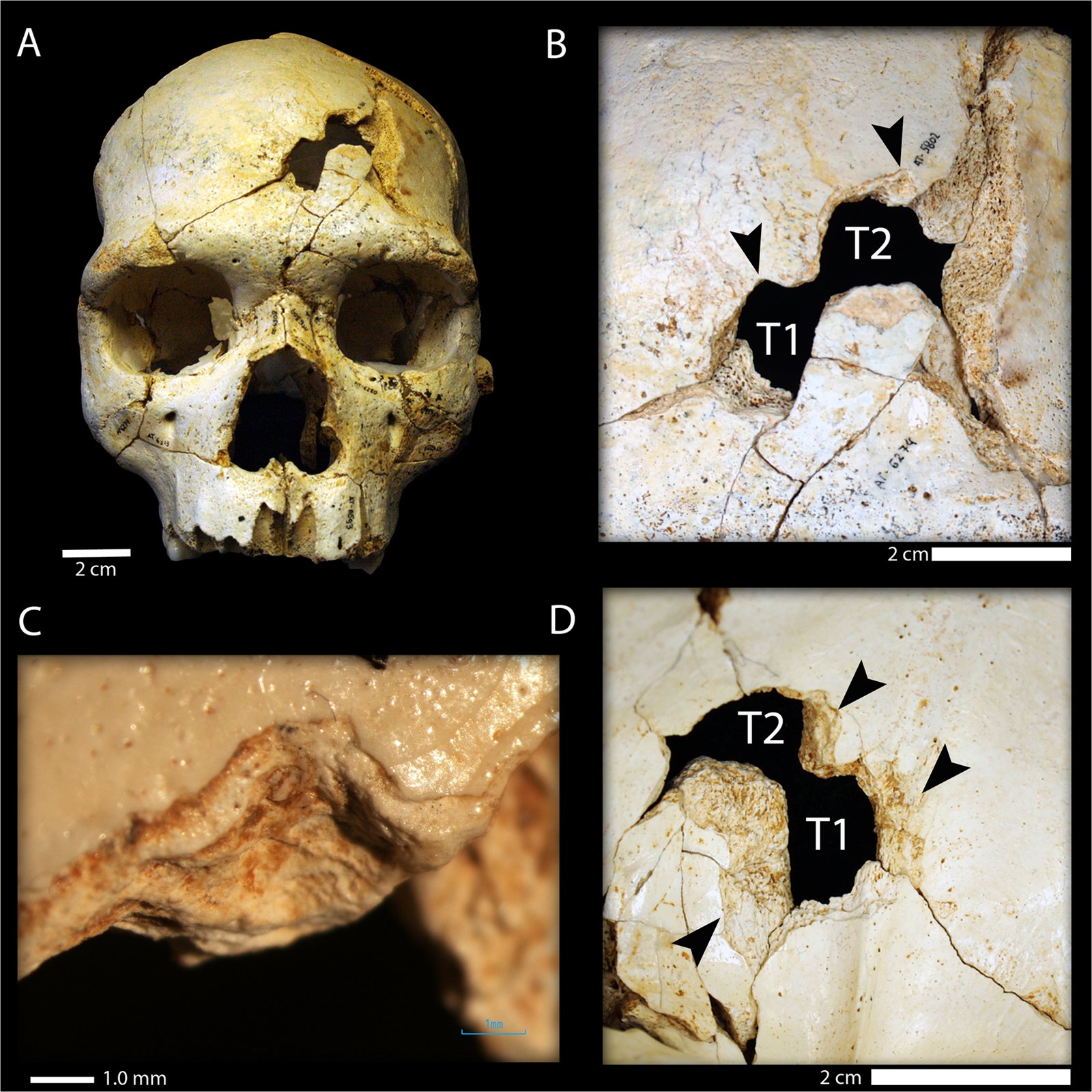 Four-panel scientific figure of Cranium 17: the front of the cream-coloured skull with a hole in the forehead, and three close views of two matching openings in the frontal bone marked T1 and T2, with scale bars