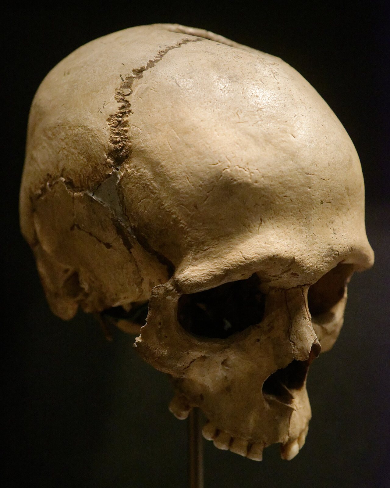 The Næs skull on a museum mount against a dark background, seen from the front left, an adult cranium with a crack across the vault and a small grey repair