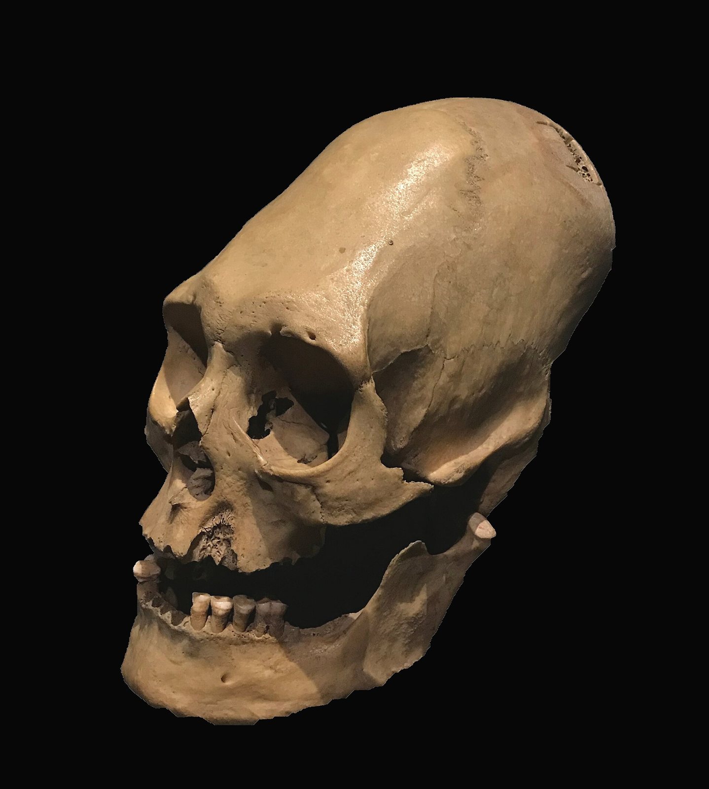 A Peruvian skull with an elongated, reshaped cranium against a black background, with a small rough-edged opening near the top at the back