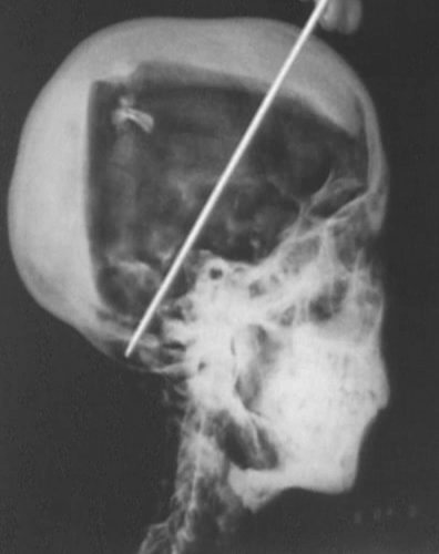 A black-and-white X-ray of a skull seen from the side, with a long thin rod crossing it diagonally and a small bright fragment near the top of the cranial cavity